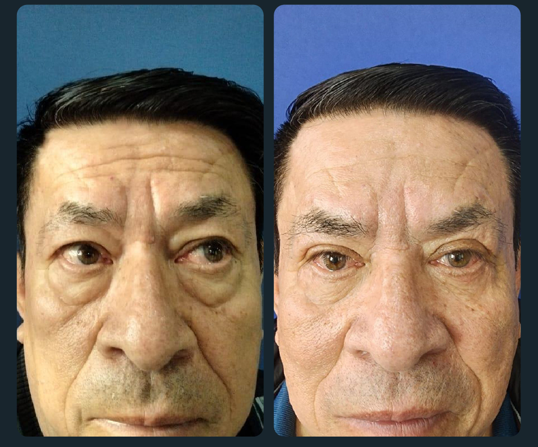 blefaroplastia
