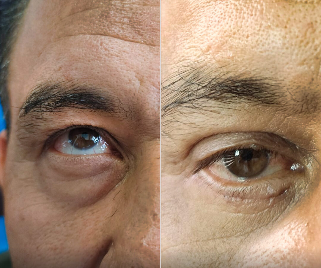 blefaroplastia
