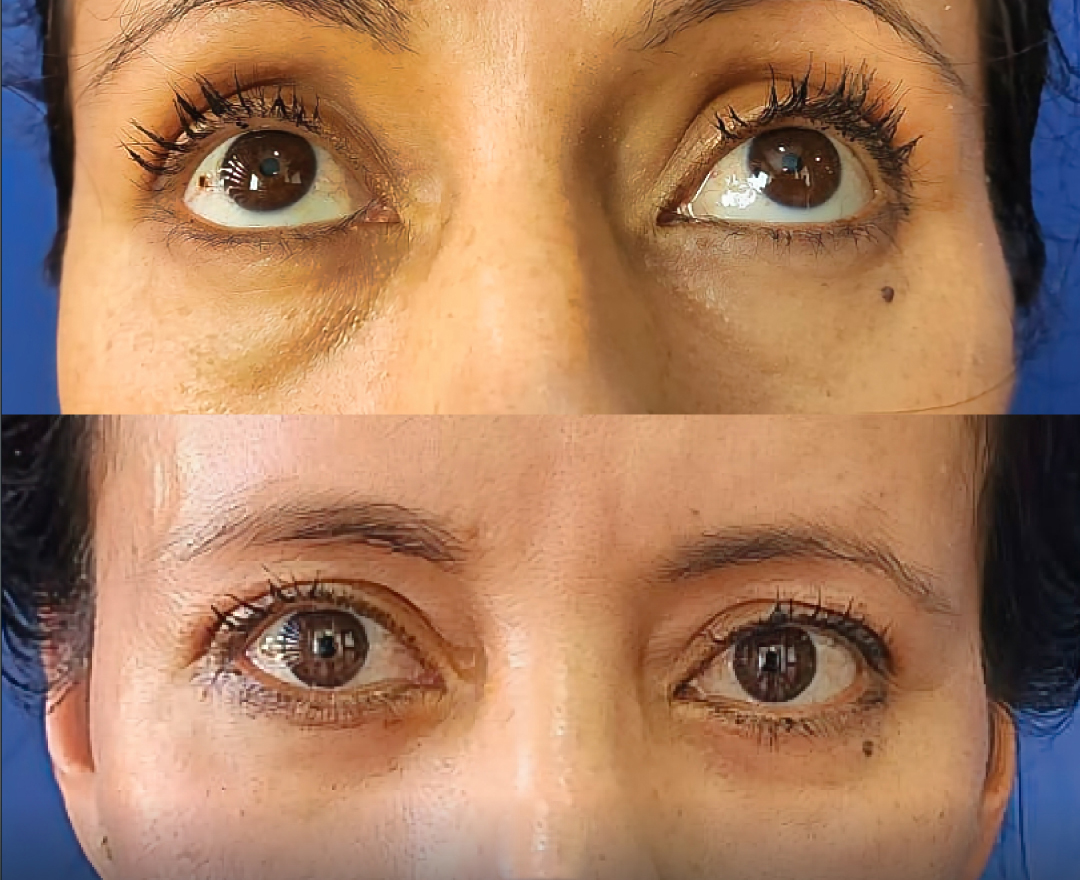 blefaroplastia