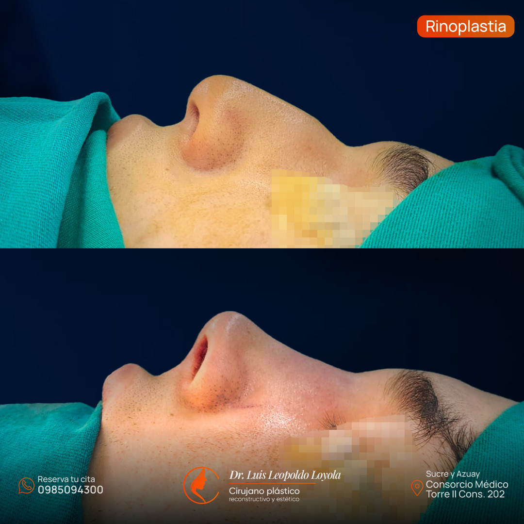 Rinoplastia loja
