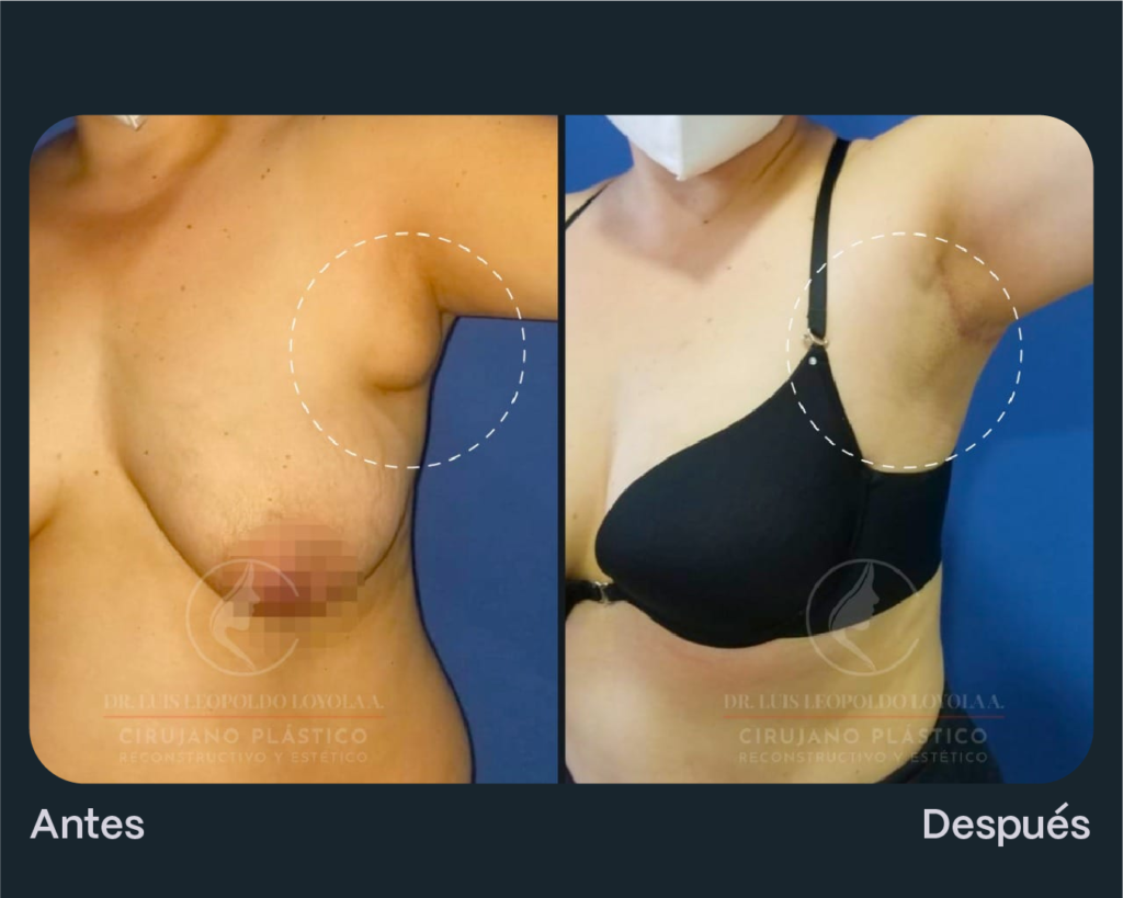 exeresis glandulas supernumerarias