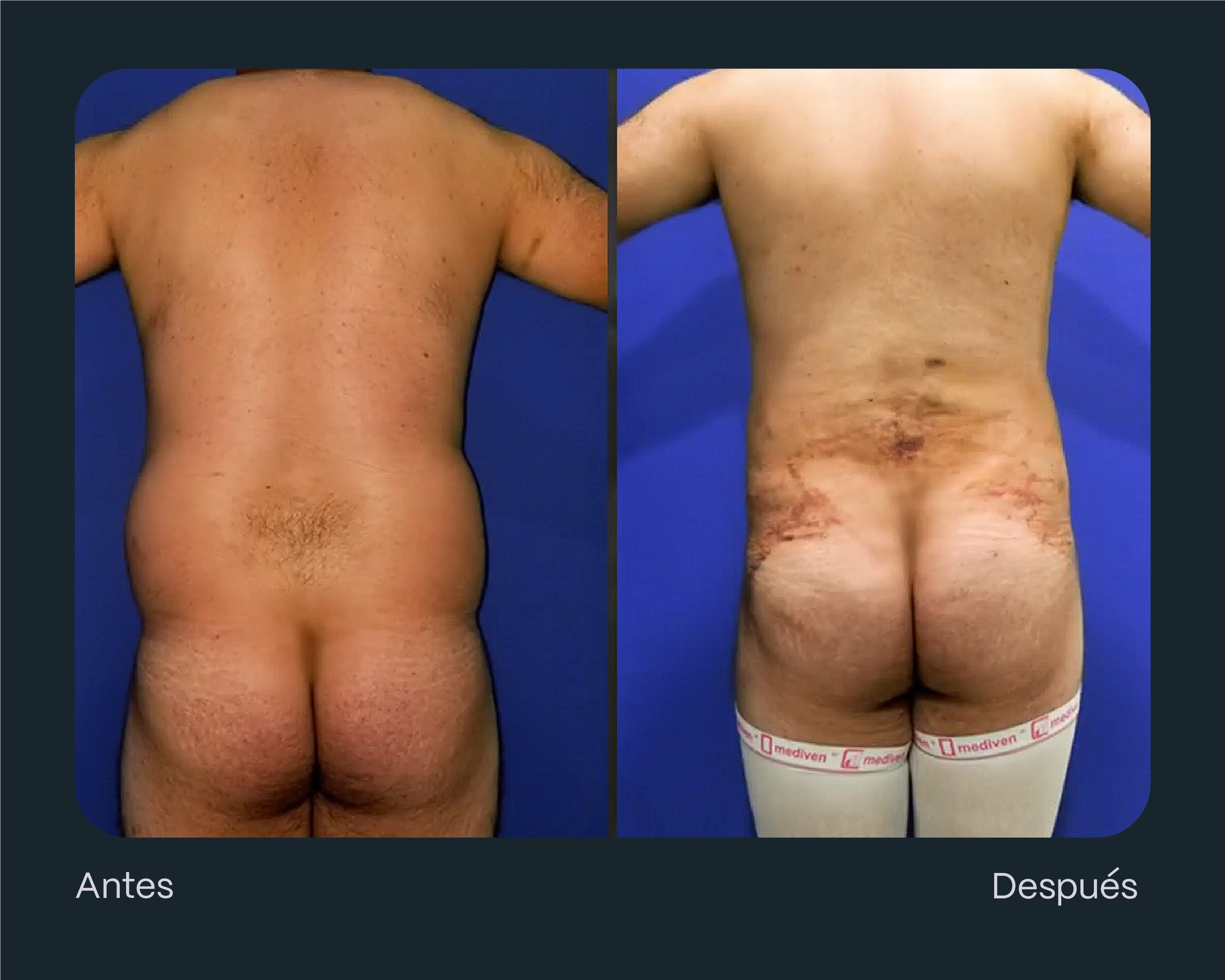 lipoescultura hombres